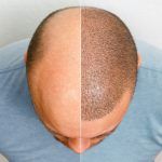 migliori cliniche trapianto capelli Italia