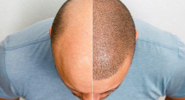 migliori cliniche trapianto capelli Italia