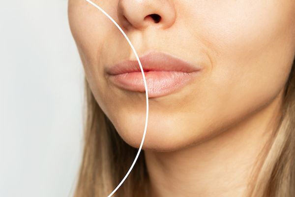 filler labbra